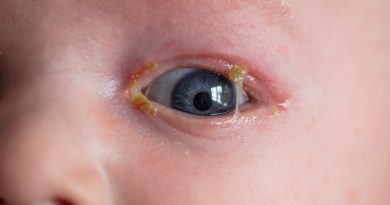 Young child with infected pink eye infection