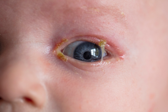 Young child with infected pink eye infection