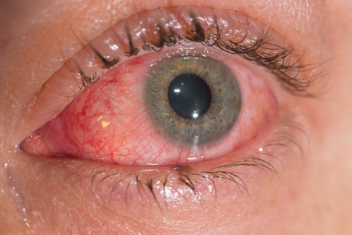 Red infected pink eye closeup