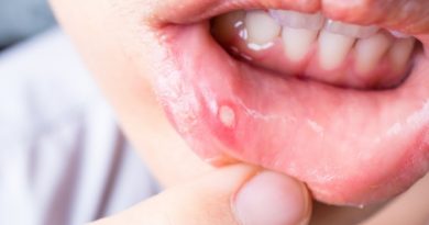 Open mouth with canker sore on inner lip