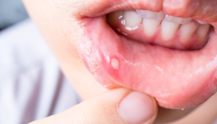 Open mouth with canker sore on inner lip