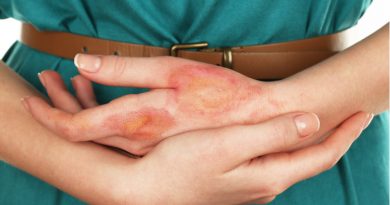 How to Handle Burns in an Emergency