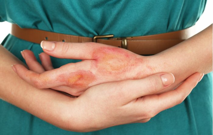 How to Handle Burns in an Emergency