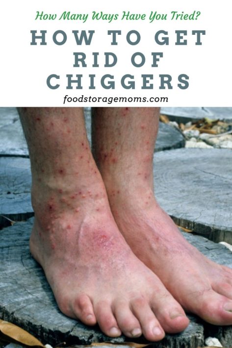 Chigger Bites on Mans Feet