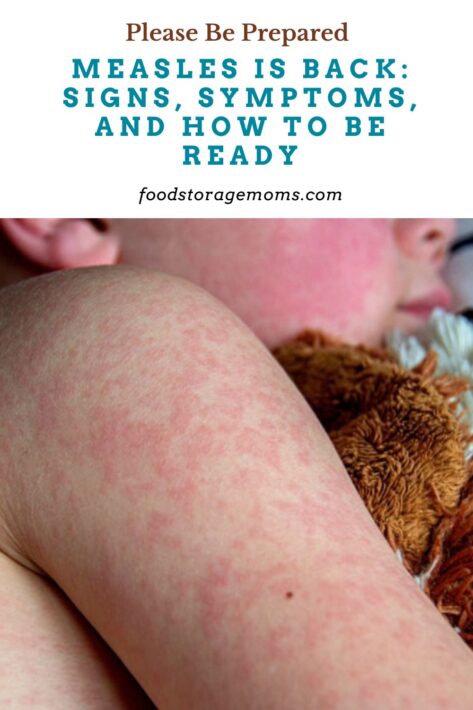 Measles Viral Disease Rash On A Child